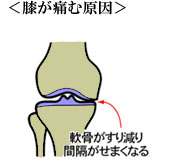 出張専門こしがや鍼灸治療所　膝の痛み　膝関節痛